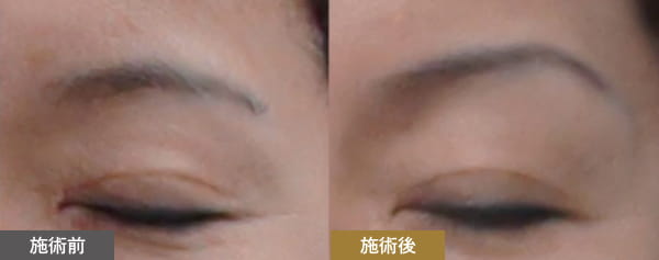 施術前・施術後