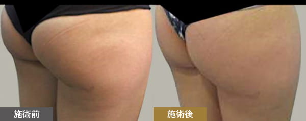 施術前・施術後