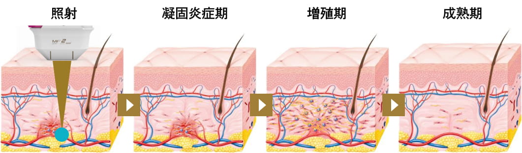 ハイフシャワーによる治療の仕組み